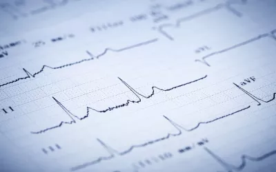 Evidencia de arritmia cardiaca Arritmia cardiaca