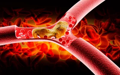 Arteriosclerosis Arteriosclerosis, cuida bien tus arterias