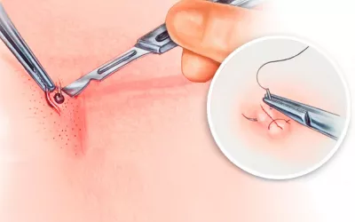 Biopsia cutánea Gráfico de una biopsia cutánea