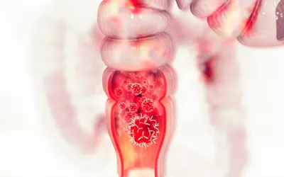 Cáncer de colon