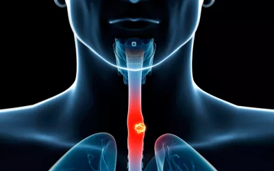 Cáncer de esófago, armas terapéuticas para combatirlo Qué es el cáncer de esófago