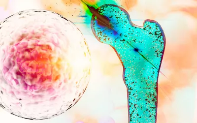 Cáncer de huesos Cáncer óseo