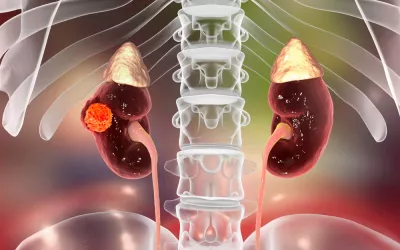 Cáncer de riñón Ubicación del cáncer de riñón