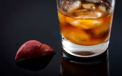 Hígado con cirrosis Hígado, cirrosis y alcohol