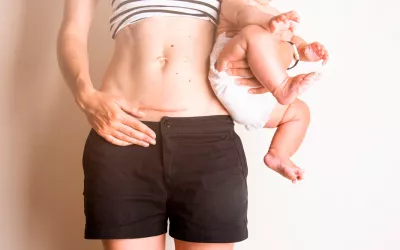 Cuidado de la cicatriz de la cesárea Mujer muestra su cicatriz por cesárea en su abdomen