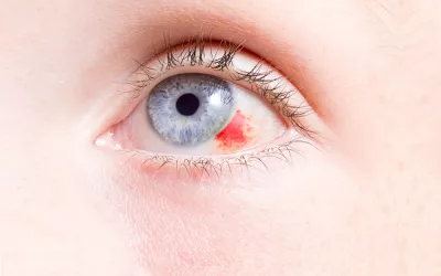 Derrame ocular Derrame ocular con hemorragia