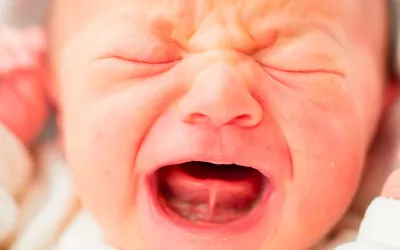 Anquiloglosia Anquiloglosia