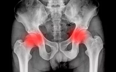 Día Mundial de la Espondilitis Anquilosante Día Mundial de la Espondilitis Anquilosante