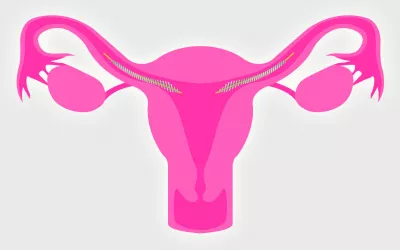 Essure, método de anticoncepción definitivo