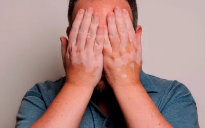 Afectados por vitíligo