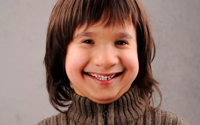 Niño con rasgos de síndrome de Williams