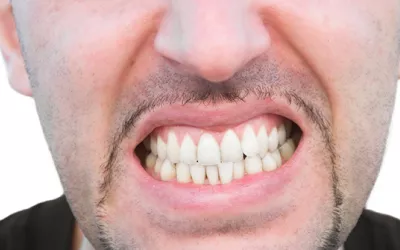 Bruxismo Bruxismo