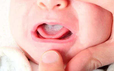 Muguet oral Muguet oral