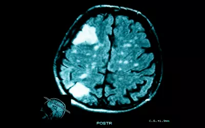 Tumor cerebral Tumores cerebrales