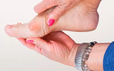 Juanetes o hallux valgus Juanetes