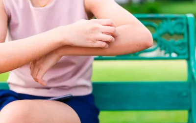 Qué es la enfermedad de Chagas Mujer rascándose el brazo por chinches que transmiten la enfermedad de Chagas