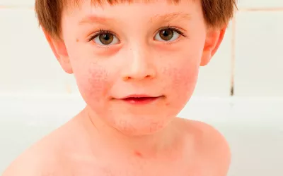 Escarlatina, una infección aún presente en la infancia Niño con escarlatina