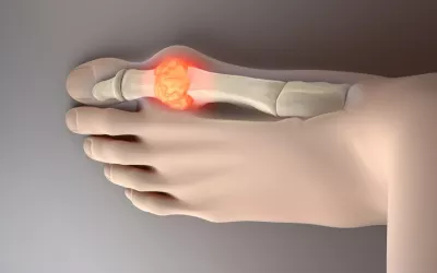 Gota y ácido úrico