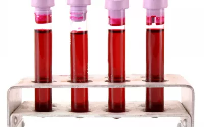 Hemocromatosis Hemocromatosis