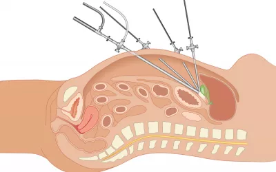 Laparoscopia Laparoscopia