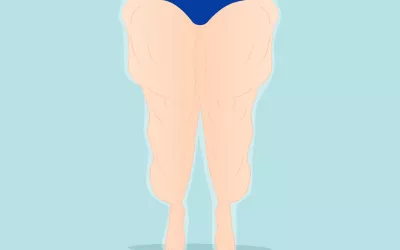 Lipedema, grasa patológica Mujer con lipedema