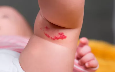 Manchas de nacimiento Manchas de nacimiento