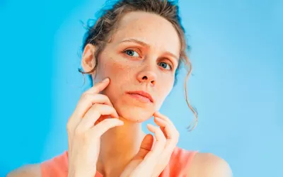 Melasma, antiestéticas manchas en la piel Melasma, antiestéticas manchas en la piel