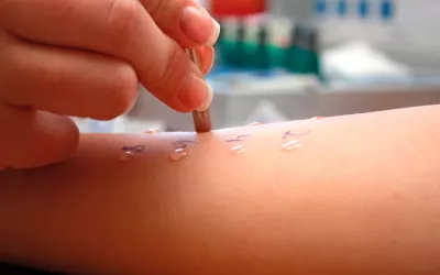 Prick test: pruebas cutáneas de alergia Prick test: pruebas cutáneas de alergia