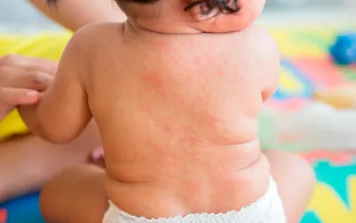 Roseola