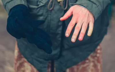Persona con sabañones en las manos