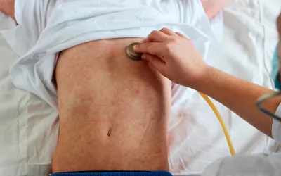 Sarampión Niño con sarampión