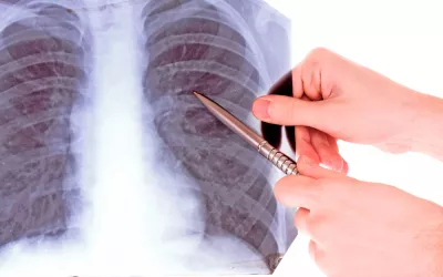 Sarcoidosis Qué es la sarcoidosis