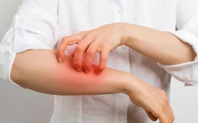 Sarcoptes scabei Sarna o escabiosis