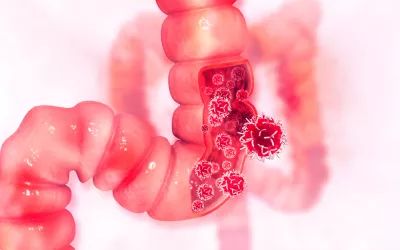 Sibo, exceso de bacterias en el intestino delgado