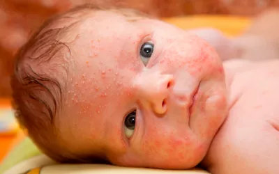 Bebé con sudamina Sudamina, consejos para evitar su aparición en bebés