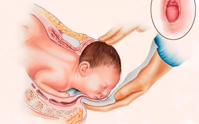 Episiotomía: preguntas frecuentes