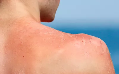 Piel pelada tras el bronceado Persona con la piel pelada por efecto del sol