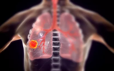 Cáncer de pulmón Infografía del áncer de pulmón