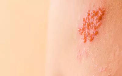 herpes zoster