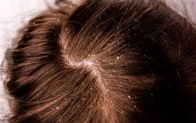 Descamación del cuero cabelludo: soluciones Descamación del cuero cabelludo