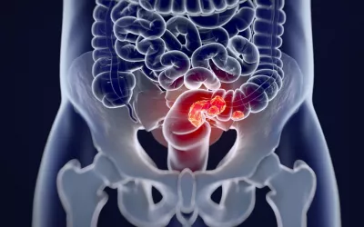 Síndrome de Lynch Síndrome de Lynch: cáncer colorrectal hereditario no polipósico