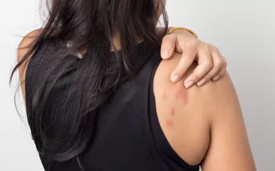 Urticaria, picores nada banales Urticaria