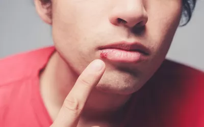 Virus del herpes Virus herpes