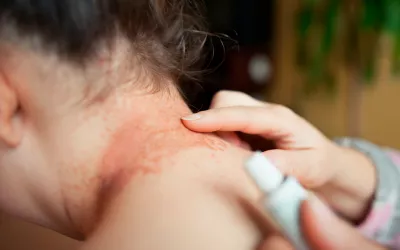 Alergia al níquel, una dermatitis muy frecuente Alergia al níquel