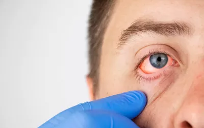 Conjuntivitis Conjuntivitis, lo mejor para aliviarla