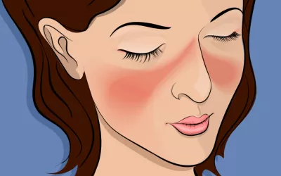 Día Mundial del Lupus Lupus