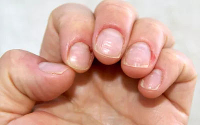 Uñas COVID, qué indican y por qué aparecen Uñas COVID