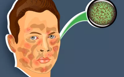 Lepra Qué es la lepra