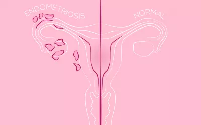 Endometriosis, cómo afecta a tus posibilidades de embarazo Endometriosis