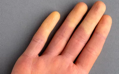 Fenómeno de Raynaud en la mano